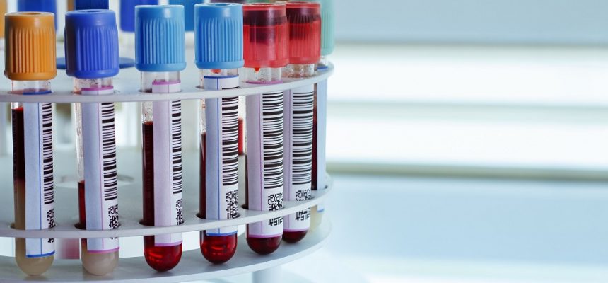 BloodVials_20976887_xl-1-860x400